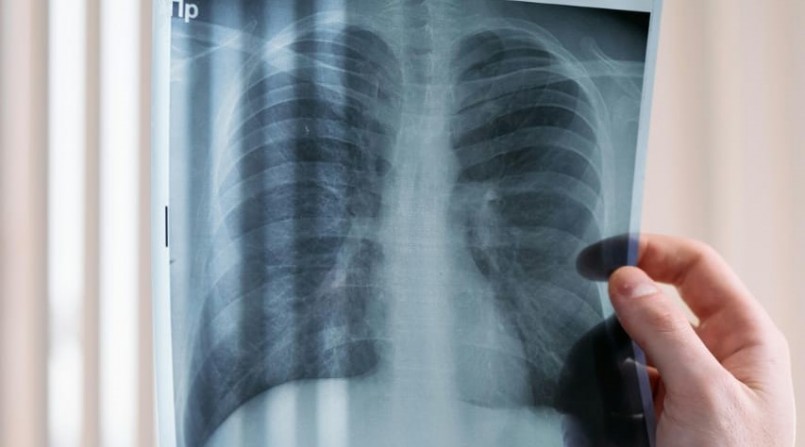Dois novos casos de câncer de pulmão são diagnosticados no HCFMB semanalmente